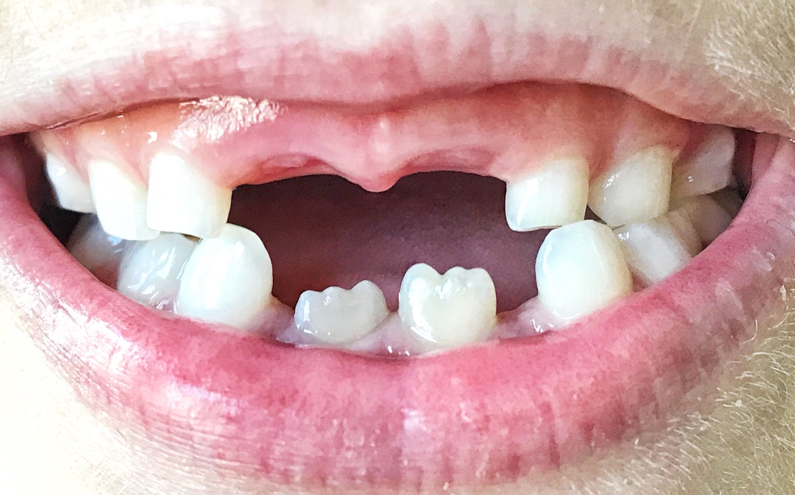 Diş Eksikliği ve Tedavileri